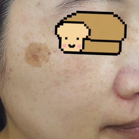 分享 明明感覺歲是還不到 卻出現曬斑 看板facelift Ptt消費區